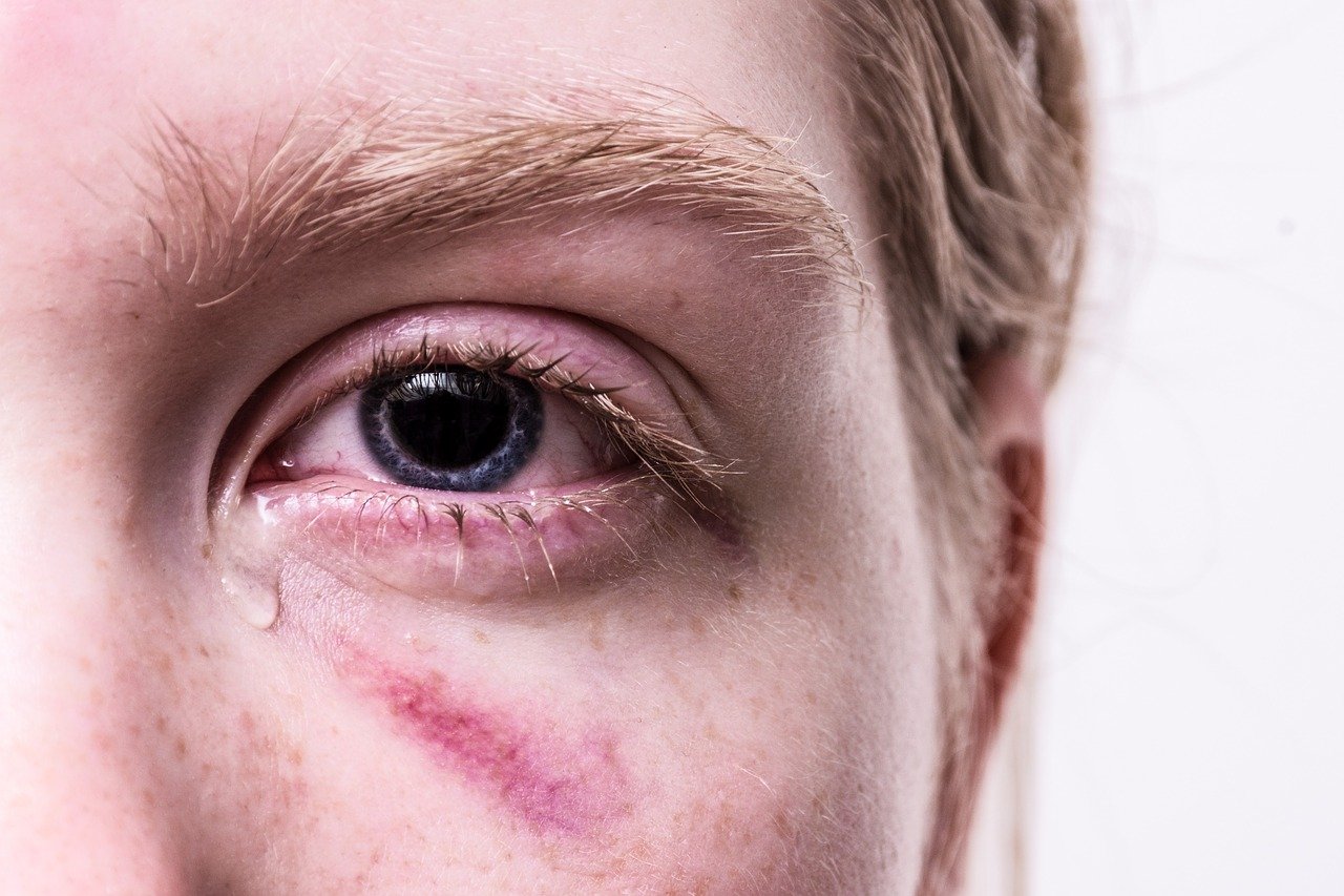 A Specialist-Approved Guide To Eye Injury: First Aid Solutions